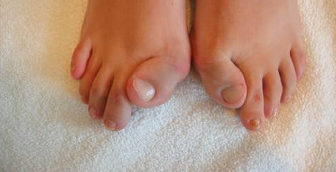 Dedos dos pés de uma criança com FOP